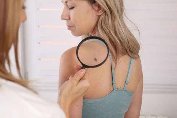 What Are Traditional Skin Lesion Removal Methods Isle of Isla?