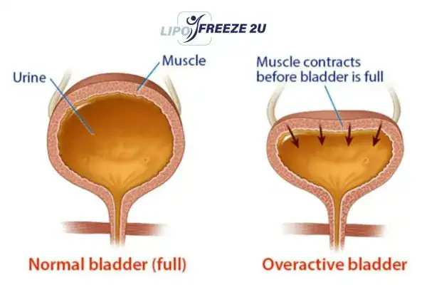 diagram of overactive bladder treatment Isle of Isla