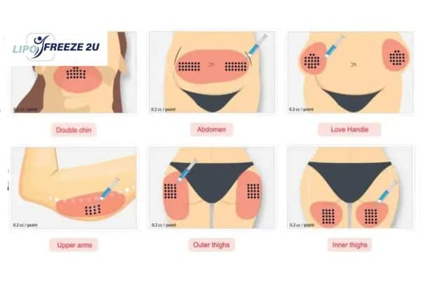 Benefits of Choosing Aqualyx for Fat Reduction Isle of Isla