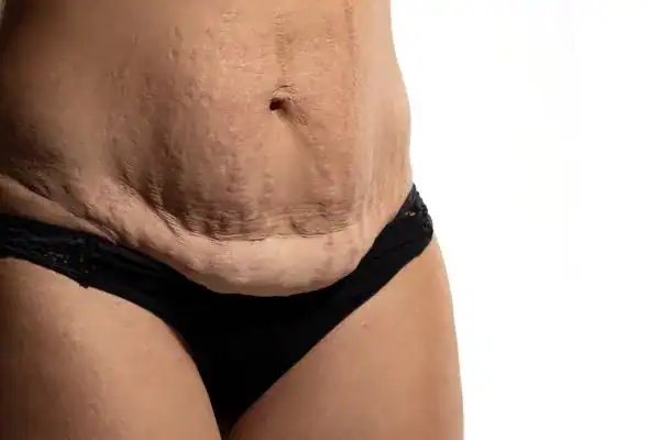 loose skin after weight loss injections Isle of Isla