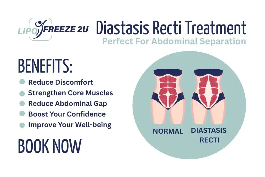 Benefits of body toning treatment Isle of Isla for Diastasis recti