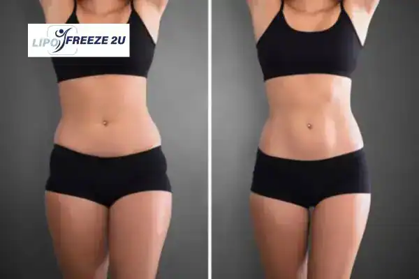 How Can LIPO FREEZE 2U Support Your Post-Pregnancy Body Recovery Isle of Isla?