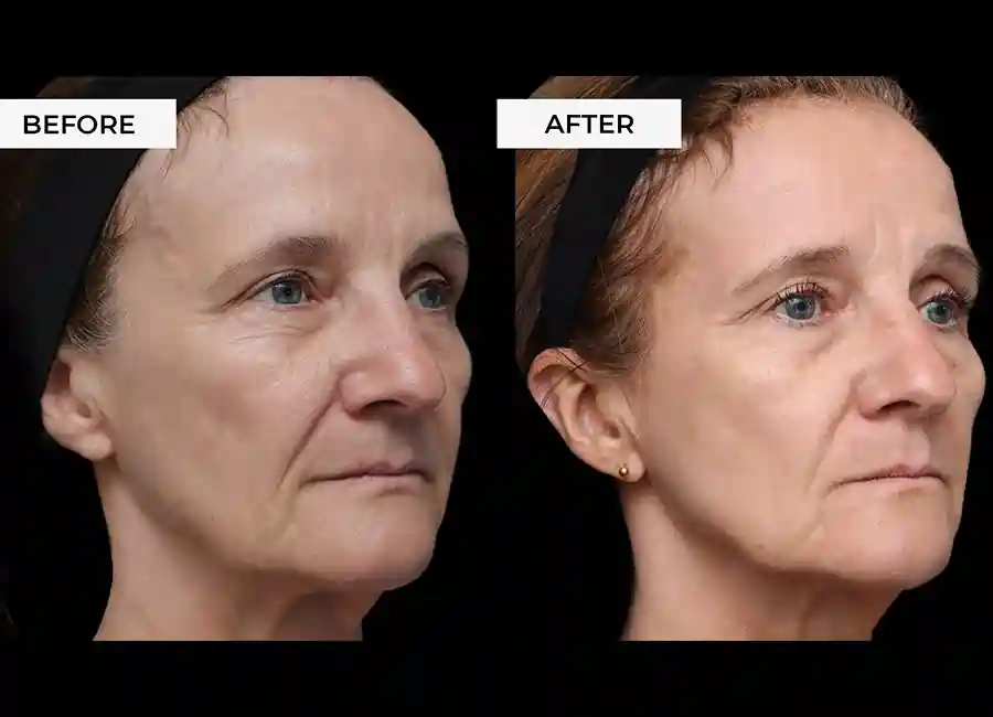 How Many RF Microneedling Sessions Will You Need to See a Difference Isle of Isla?