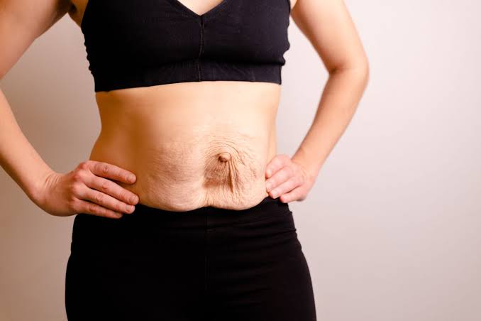 Is Surgery Really the Only Way to Repair Diastasis Recti Isle of Isla?