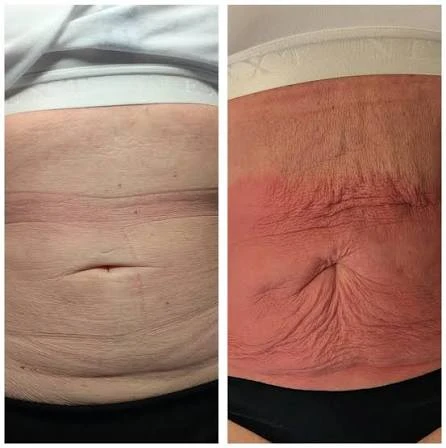 How Does RF Microneedling Improve Crepey, Thin and Uneven Skin Texture Isle of Isla?