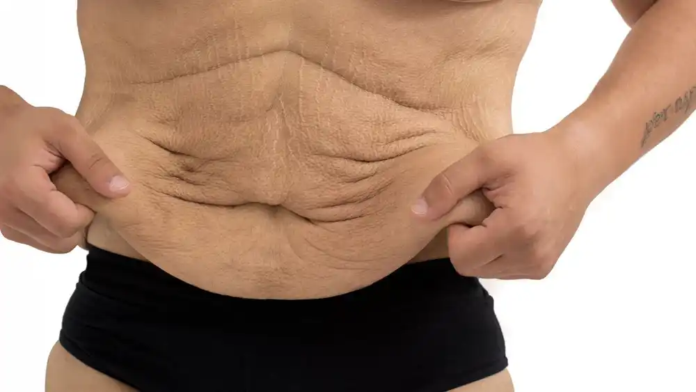 Why Does Weight Loss Medication Leave Some People With Loose or Sagging Skin Isle of Isla?
